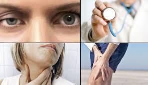 The most commonly affected muscles are those of the eyes, face, and swallowing. Myasthenia Gravis Und Schwangerschaft Dr Camargo Mario Villarreal Neurologe