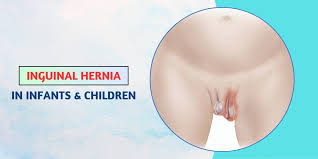 Image result for Inguinal hernia child