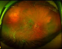 Retinal tears when a retinal tear or hole hasn't yet progressed to detachment, your eye surgeon may suggest one of the following procedures to prevent retinal detachment and preserve vision. What The Fundus New Website For Sharing Optos Retinal Images Eyedolatry