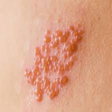 A herpes virus that causes cold sores and fever blisters in and around the mouth. Genital Herpes In Men Symptoms And Treatment Roman Healthguide