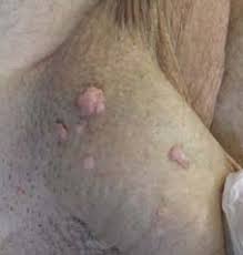 Gardasil erkekler ve erkekler tarafından kullanılması onaylanmamıştır. Erkeklerde Hpv