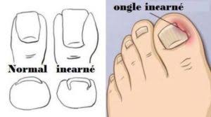 Pour un effet optimal, ajoutez. Ongle Incarne Ou Pas Comment Reconnaitre Et Soigner
