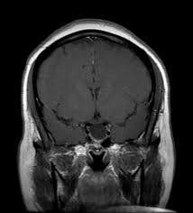 Empty Sella Syndrome Wikidoc