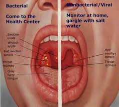 When A Sore Throat Means A Doctor Visit Treatment For Sore Throat Nursing Tips Viral Sore Throat