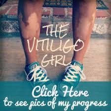 Vitiligogirlprofilepic1 Vitiligo Cure Vitiligo Treatment Vitiligo