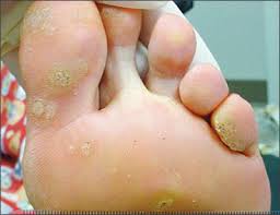 Plantar Warts Verrucae Commonly Known As Fish Eyes Almawi Limited The Holistic Clinic