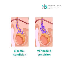 Image result for Varicocele