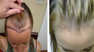 We did not find results for: Dieses Kraut Stoppt Haarausfall Und Lasst Es Wie Verruckt Wachsen Youtube