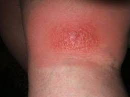 Ant Bites That Look Like Mosquito Bites Pin On Spider Bites