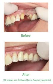 Dental bridges are used to fill the gaps between existing teeth when others have been lost or must be pulled. What Are Dental Bridges And Who Should Get Them Smile Yorktown