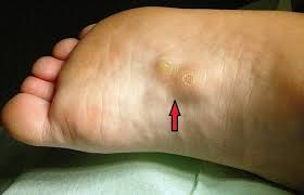 It develops in the plantar fascia, which is thick, fibrous tissue at the bottom of your feet. Treatment For Plantar Fibroma Foot Pain Explored