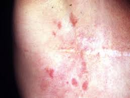 It affects people of all races, genders and ages, which is why it's absolutely critical for americans to learn about. Cutaneous Metastasis Dermnet Nz
