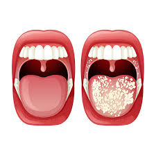 Image result for Candidiasis