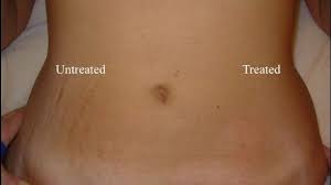 How To Get Rid Of Stretch Marks Fast Stretch Marks Removal Remedies Stretch Mark Remedies Beauty Remedies Beauty Hacks
