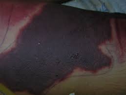 Severe congenital protein c (pc) deficiency (scpcd) is associated with disseminated intravascular coagulation (dic), purpura fulminans (pf), and vascular thromboembolic events (te), often leading to organ failure and death. Disseminated Intravascular Coagulation Dermnet Nz