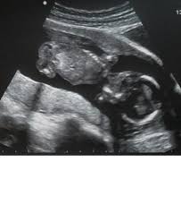 D ab wann muss ich die. Geschlecht Auf Bild Erkennen Kann Mir Jemand Ne Antwort Geben Was Man Da Sieht Schwangerschaft Baby Frauenarzt