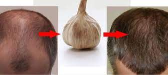 Once you've identified the cause of your hair loss, you can more easily find the best remedy. All You Need To Know About Selecting The Best Hair Loss Treatment Critical Health Care