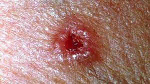 They are most commonly the result of allergies or infection, though there are many possible causes. Skin Cancer Rash Itchiness And Symptoms