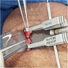 ¿cómo se reduce el sangrado después de la vasectomía? Tratamiento Quirurgico De La Infertilidad Masculina Sciencedirect