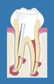 Since front teeth usually do not have more than one canal, the process usually is completed within 30 minutes. Root Canal Treatment Praxis Am Kureck