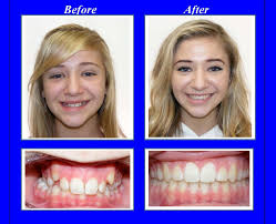 This Patient Had A Very Narrow Upper Jaw And Her Back Teeth Were In Crossbite On Her Right Side We Expanded Her Upper Ja Orthodontics Dental Braces Crossbite