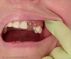 A loose permanent tooth, however, is a cause for concern. Home Remedies To Fix A Broken Or Cracked Tooth