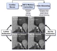 This service is provided by intelligent cv at no cost and is intended for use as is. Intelligent Motion Correction Significantly Impacts The Volumes Of Calcium Blooming Artifacts For Coronary Computed Tomography Angiography Ccta Journal Of Cardiovascular Computed Tomography