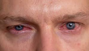 Mencuci mata yang dijangkiti menggunakan kapas ataupun tisu dalam beberapa kali sehari. Bahaya Pterygium Selaput Putih Pada Bola Mata