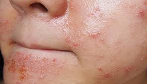 Causes of ingrown hairs, what they Side Effects Of Waxing You Must Be Aware About Lifeberrys Com