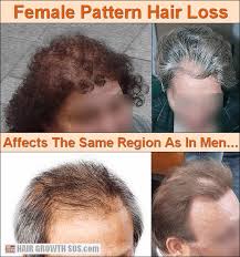 Female Pattern Hair Loss In Women Affects The Same Area As In Men But Usually Causes Thinning Not B Hair Loss Cure Hair Growth Tips Hair Loss Treatment Shampoo