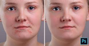 To have your skin texture layer blend in with your softened skin layer below it, go learn how to do more in professional portrait retouching techniques for photographers using photoshop. Remove Acne And Skin Blemishes In Photoshop Photoshop Essentials