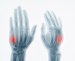 Check spelling or type a new query. Sports Injuries Hand And Wrist Dr Saurabh Aggarwal