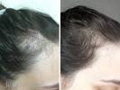 Frontal Hair Thinning
