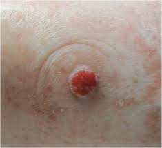 Image result for Papule