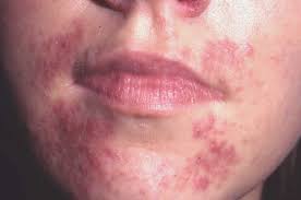 Allergi och överkänslighet kan visa sig i form av eksem, torra fläckar, röda prickar eller svullen och rodnande hud. Rosacea Netdoktorpro Se