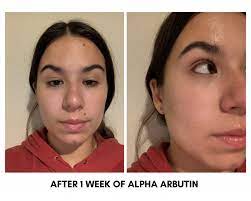 This item is excluded from promo. The Ordinary Alpha Arbutin Serum Before And After Seknd Blog