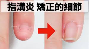 指溝炎甲溝炎 能不能做凝膠指甲 特殊狀況做指甲示範in 2021 nails beauty