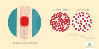 Anemia Aplastik Gejala Diagnosis Pengobatan