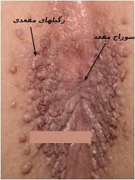 رابطه مقعدي عکس مقعده سالم. Ø¯Ù„Ø§ÛŒÙ„ Ø§Ø¨ØªÙ„Ø§ Ø¨Ù‡ Ø²Ú¯ÛŒÙ„ Ù…Ù‚Ø¹Ø¯ÛŒ Ø¯Ø± Ø²Ù†Ø§Ù† Ùˆ Ù…Ø±Ø¯Ø§Ù† Ùˆ Ø±ÙˆØ´ Ù‡Ø§ÛŒ Ø¯Ø±Ù…Ø§Ù† Ø¢Ù† Ø¯Ø±Ù…Ø§Ù† Ú©Ù„ÛŒÙ†ÛŒÚ©