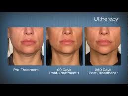 Ultherapy Before After Pictures At Laser Clinique In San Diego Ultherapy Ultherapy Before And After Laser Skin Tightening
