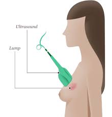 How do i know if i have breast cancer? Breast Cancer Diagnosis National Breast Cancer Foundation