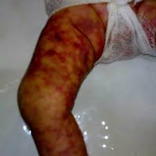 Acute infectious pf occurs most commonly in the setting of meningococcemia due to elaboration of endotoxin. Clinical Photograph Showing Extensive Lesions Of Purpura Fulminans Download Scientific Diagram