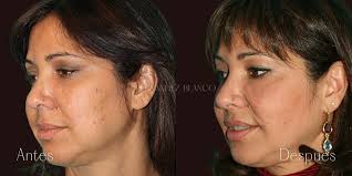 Carolina's case : Before and after Bichat Balls : FB