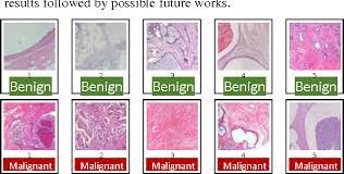 Benign neoplasms do not invade or metastasise (spread), whereas malignant. Classification Of Histopathology Images Of Breast Into Benign And Malignant Using A Single Layer Convolutional Neural Network Semantic Scholar