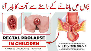 Image result for Rectal Prolapse