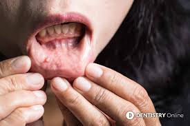 Still, if you have these symptoms, you should have them checked by a doctor or nurse. Mouth Cancer Reported Spike After Dental Access Issues Dentistry Co Uk