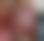 Image result for spinocellular carcinoma of the oral cavity