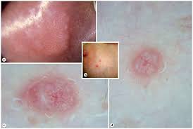 Image result for genital warts