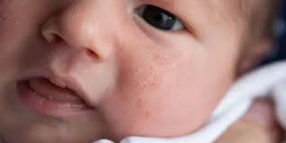 Image result for sweat rash on back baby