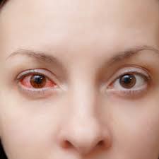 This Is The Fastest Way To Get Rid Of Pink Eye According To Doctors Pink Eye Treatment Pink Eyes Pink Eye Drops